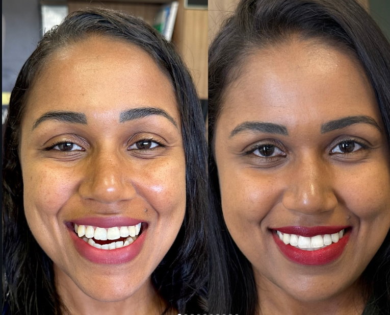Antes e depois — procedimento 1